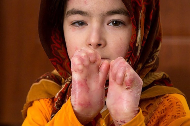 انواع بیماری پروانه ای و درجات آن