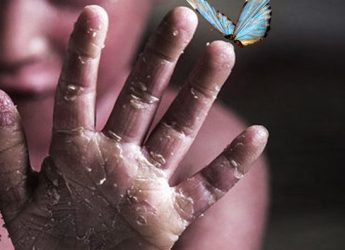 بیماری پروانه ای از چه سنی شروع می‌شود؟